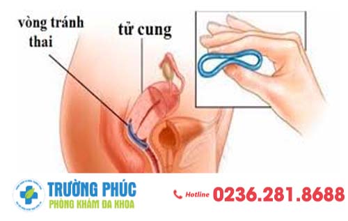 Đặt Vòng Tránh Thai IUD Đặt Khi Cần Tránh Tháo Khi Cần Có