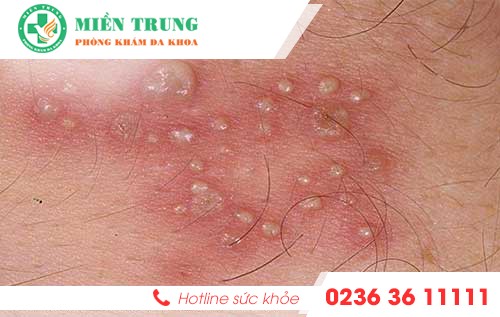 dau hieu cho thay vung kin co nguy co mac benh