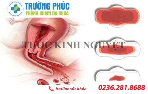 Phụ nữ bị tước kinh nguyệt cần làm gì để chấm dứt tình trạng này?