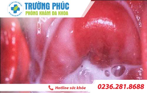 viem nam am dao candida