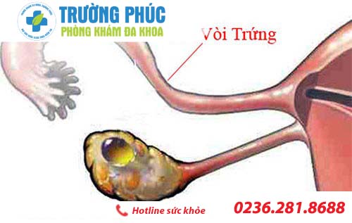 nguyen nhan gay vo sinh o nu gioi