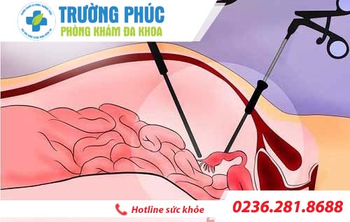 Chữa polyp cổ tử cung bằng cách nào thì hiệu quả?