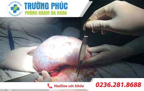 chữa u nang buồng trứng bằng cách nào chua u nang buong trung bang cach nao