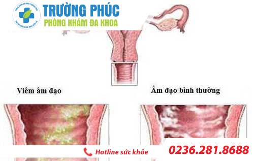 Hình ảnh viêm âm đạo ở nữ giới