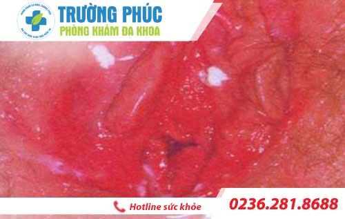 hinh anh benh viem am dao o nu gioi