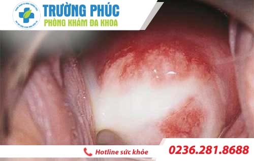 hinh anh benh viem am dao o nu gioi