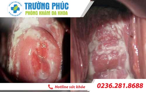 hinh anh benh viem am dao o nu gioi