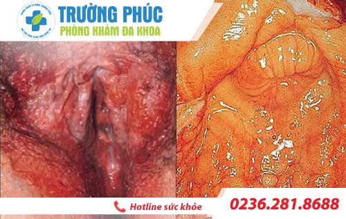 hinh anh benh viem am dao o nu gioi