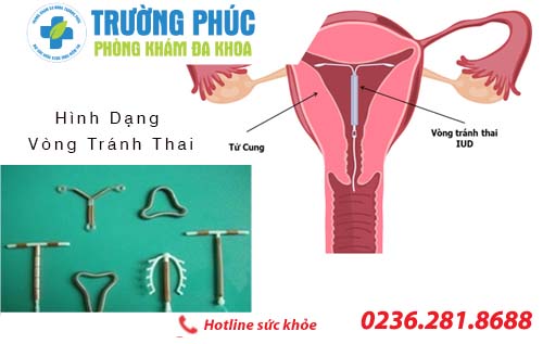 Đặt vòng tránh thai – Những điều chị em cần biết