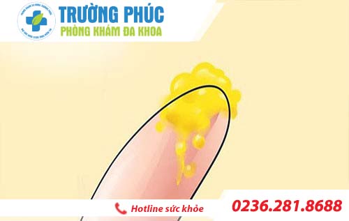 Huyết trắng ra nhiều là dấu hiệu bệnh phụ khoa nào chăng?