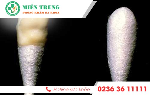 khu hu dac va von cuc la bieu hien cua benh gi 