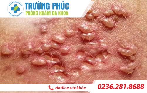 dau hieu mun rop sinh duc