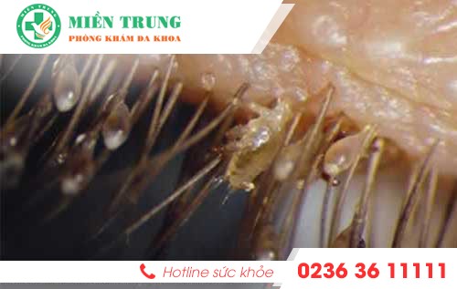 ngua vung kin dau hieu nhieu benh