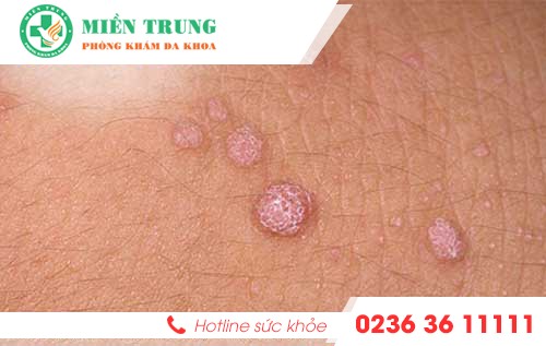 ngua vung kin dau hieu nhieu benh