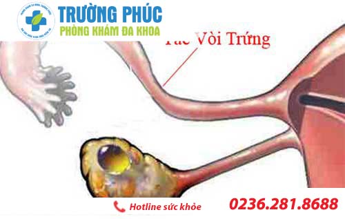 nguyen nhan gay tac voi trung va cach dieu tri 