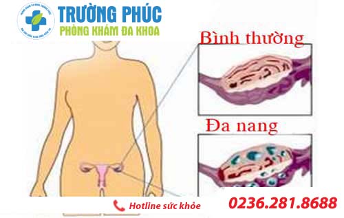 nguyen nhan va cach dieu tri benh u nang buong trung