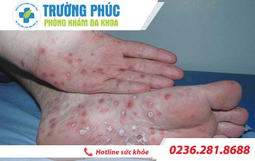 nhận biết biểu hiện bệnh giang mai ở nữ giới nhan biet nhung bieu hien benh giang mai o nu gioi