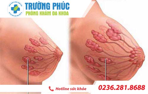 Nhận biết dấu hiệu bệnh viêm tuyến vú