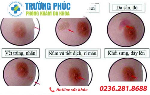 dau hieu benh viem tuyen vu