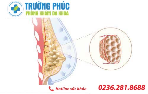 Những điều cần biết về bệnh tăng sinh tuyến vú