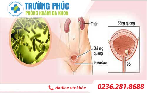 Đừng chủ quan khi bị viêm đường tiết niệu