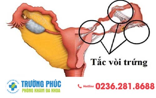 Cảnh báo những nguyên nhân gây vô sinh nữ giới