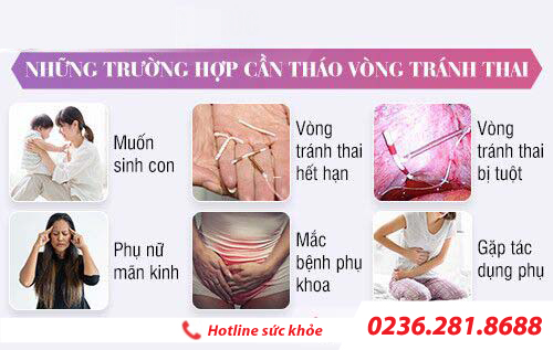 Tháo vòng tránh thai: an toàn, nhanh chóng và không đau