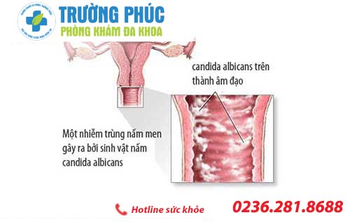 Tìm hiểu về bệnh viêm âm đạo