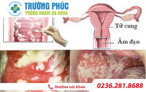 tim hieu ve benh viem am dao o nu gioi