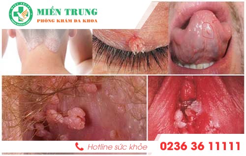 trieu chung benh sui mao ga