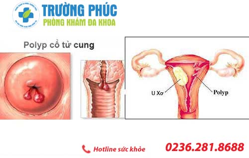 Triệu chứng nhận biết bệnh polyp cổ tử cung