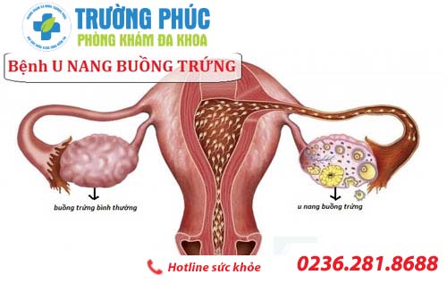 Tác hại của u nang buồng trứng có thể gây ra cho nữ giới là gì?