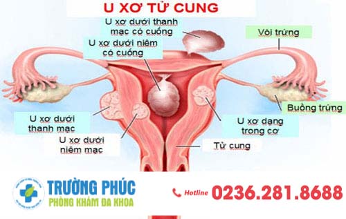 U xơ tử cung gây nên những tác hại gì cho người phụ nữ?
