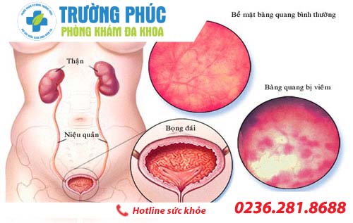 Viêm bàng quang ở nữ: Dấu hiệu và nguyên nhân gây bệnh