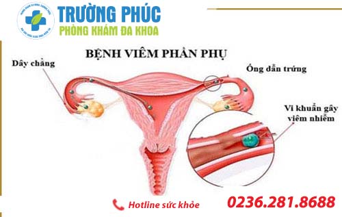 Viêm phần phụ là bệnh gì?