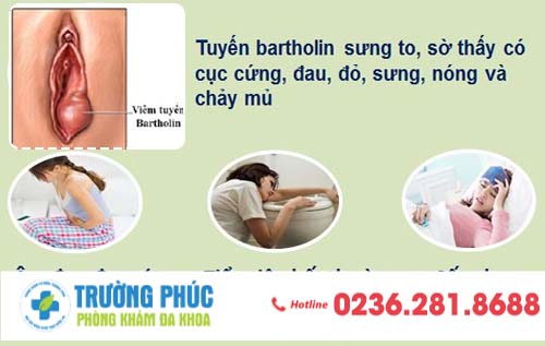 Viêm tuyến bartholin là gì? có gây nguy hiểm không?